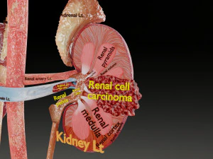 Renal cell carcinoma 3D Model