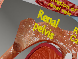 Renal cell carcinoma 3D Модель