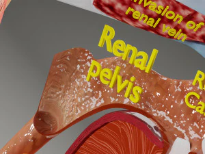 Renal cell carcinoma 3D Model