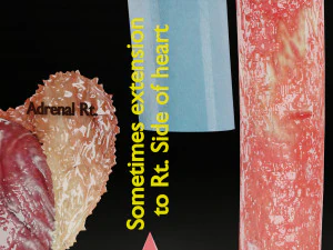 Renal cell carcinoma 3D Model