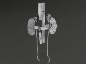 Renal cell carcinoma 3D Model