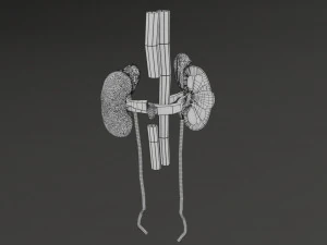 Renal cell carcinoma 3D Model
