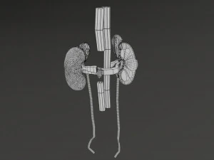 Renal cell carcinoma 3D Model