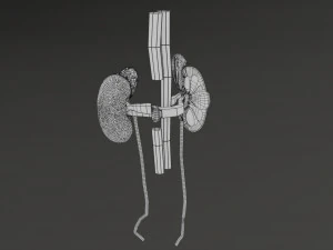 Renal cell carcinoma 3D Model