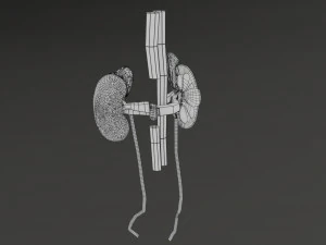 Renal cell carcinoma 3D Model