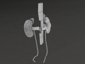 Renal cell carcinoma 3D Model