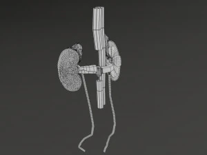 Renal cell carcinoma 3D Model