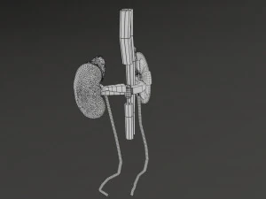 Renal cell carcinoma 3D Model