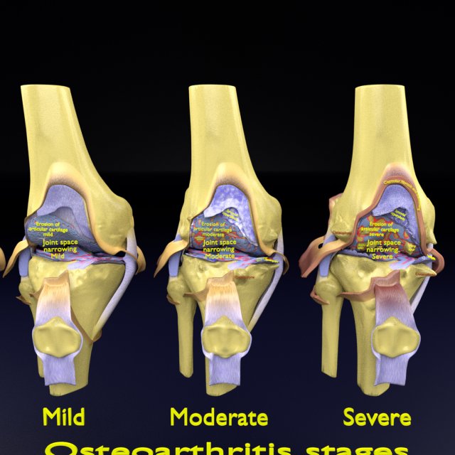 Osteoarthritis stages 3D Modelo 3D .c4d .max .obj .3ds .fbx .stl .blend 