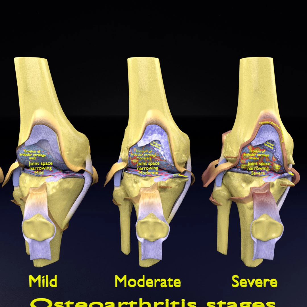 Osteoarthritis stages 3D 3D Model .c4d .max .obj .3ds .fbx .stl .blend