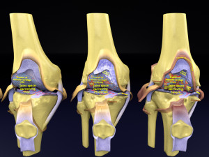 Osteoarthritis stages 3D 3D Model