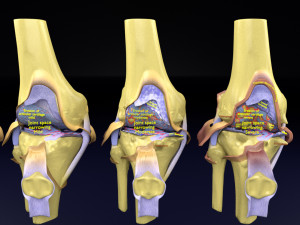 Osteoarthritis stages 3D 3Dモデル
