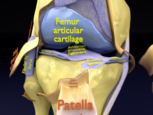 Osteoarthritis stages 3D Modelo 3D