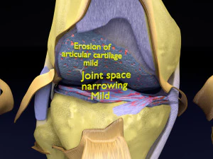 Osteoarthritis stages 3D 3D Model