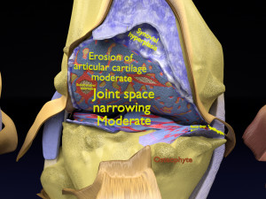 Osteoarthritis stages 3D Modelo 3D