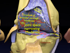 Osteoarthritis stages 3D 3D Model