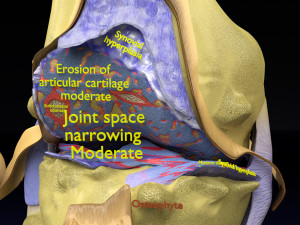 Osteoarthritis stages 3D Modelo 3D