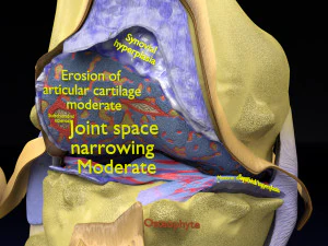 Osteoarthritis stages 3D 3D Model