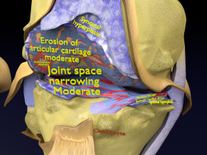 Osteoarthritis stages 3D Modelo 3D