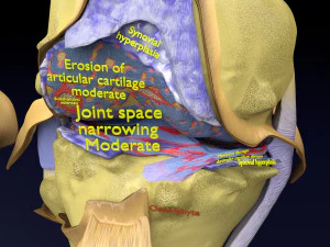 Osteoarthritis stages 3D 3D Model