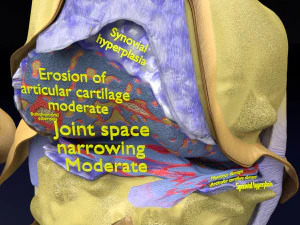 Osteoarthritis stages 3D 3D Model