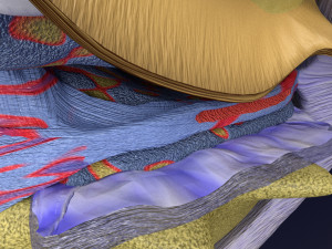 Osteoarthritis stages 3D Modelo 3D