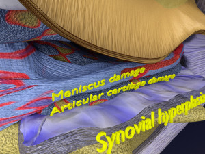 Osteoarthritis stages 3D Modelo 3D