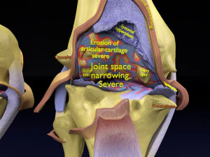 Osteoarthritis stages 3D 3D Model