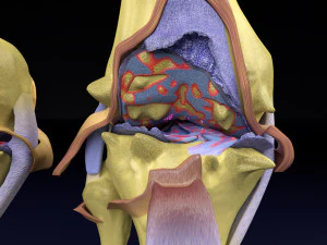 Osteoarthritis stages 3D 3D Model