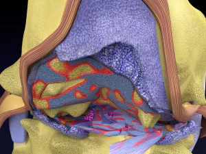 Osteoarthritis stages 3D 3D Model
