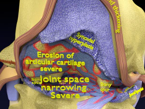 Osteoarthritis stages 3D 3D Model