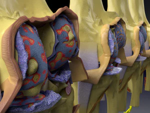 Osteoarthritis stages 3D 3D Model