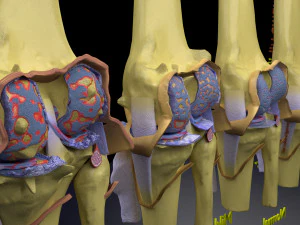 Osteoarthritis stages 3D 3D Model