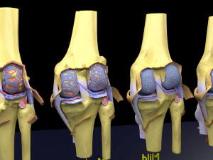 Osteoarthritis stages 3D 3D Model