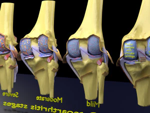 Osteoarthritis stages 3D 3D Model