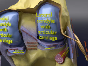 Osteoarthritis stages 3D 3D Model