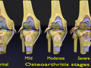 Osteoarthritis stages 3D Modelo 3D