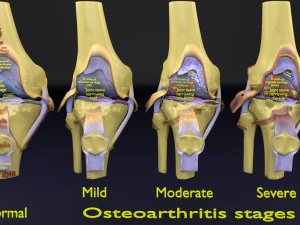 Osteoarthritis stages 3D 3D Model