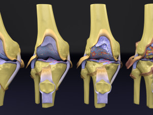 Osteoarthritis stages 3D Modelo 3D