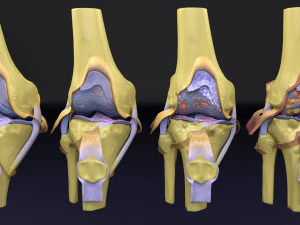 Osteoarthritis stages 3D 3D Model