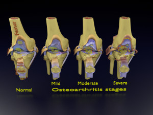Osteoarthritis stages 3D Modelo 3D