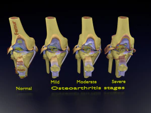 Osteoarthritis stages 3D 3D Model