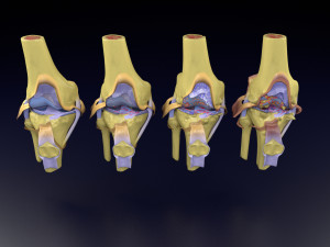 Osteoarthritis stages 3D Modelo 3D