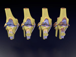 Osteoarthritis stages 3D 3D Model