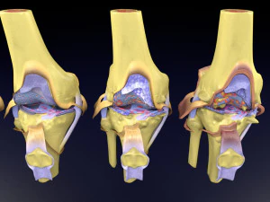 Osteoarthritis stages 3D 3D Model