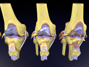 Osteoarthritis stages 3D Modelo 3D