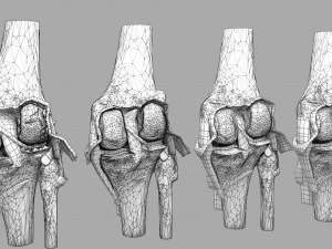 Osteoarthritis stages 3D 3D Model