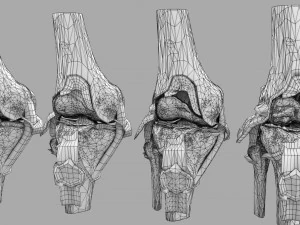Osteoarthritis stages 3D 3D Model