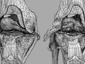Osteoarthritis stages 3D 3D Model