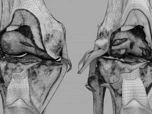 Osteoarthritis stages 3D 3D Model
